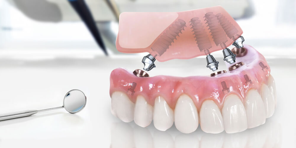 All-on-4 Implants in Turkey